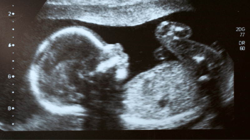 Tỷ lệ làm tổ, mang thai lâm sàng và sảy thai giữa chuyển phôi tươi và phôi trữ đông không có sự khác biệt đáng kể