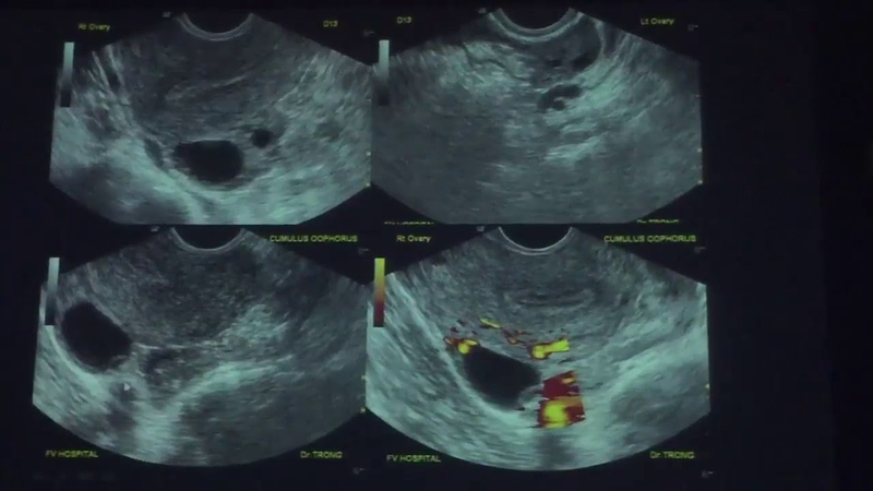 Nên đi siêu âm canh trứng vào thời điểm nào 3