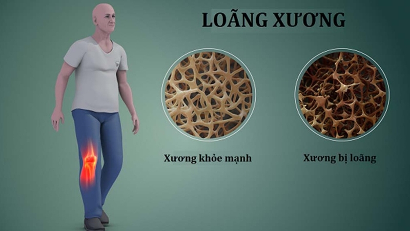 Nên dùng thuốc điều trị loãng xương trong bao lâu thì dừng lại? 1