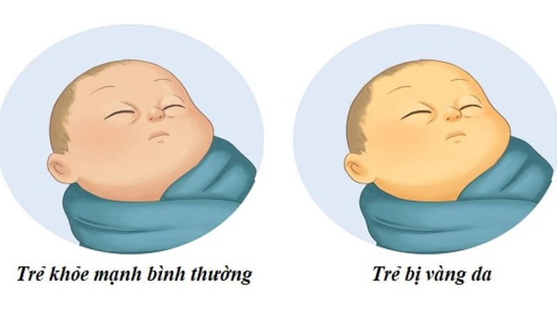 Da của trẻ sơ sinh sẽ có màu vàng, thậm chí là vàng ở cả lòng trắng