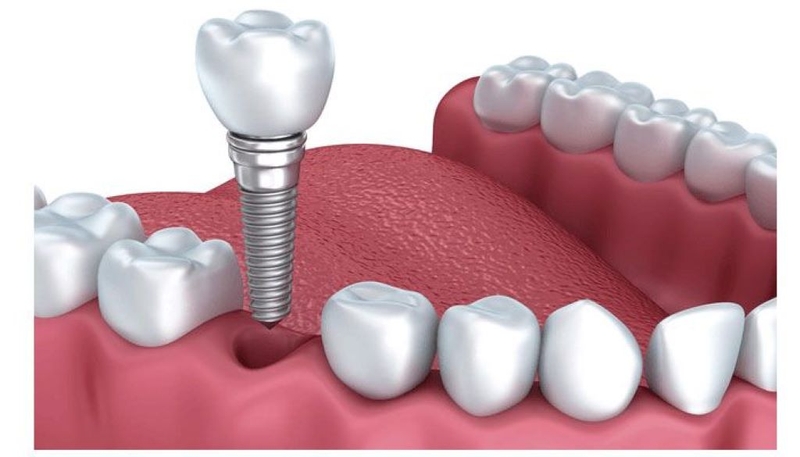 Nên làm cầu răng hay implant? Phương pháp nào tốt hơn? 2
