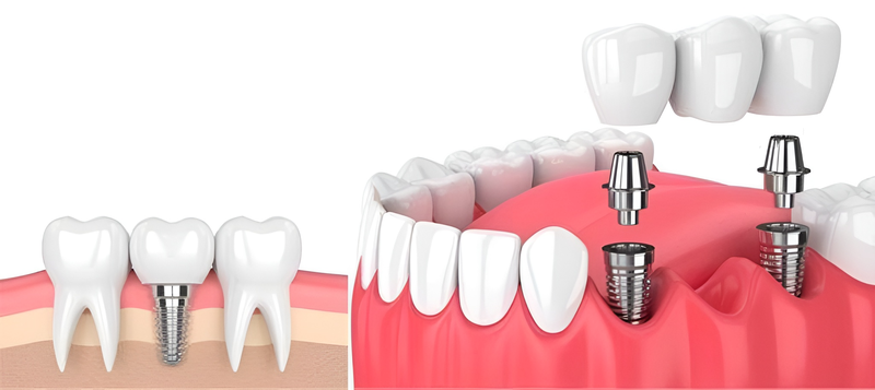 Nên làm cầu răng hay implant? Phương pháp nào tốt hơn? 3