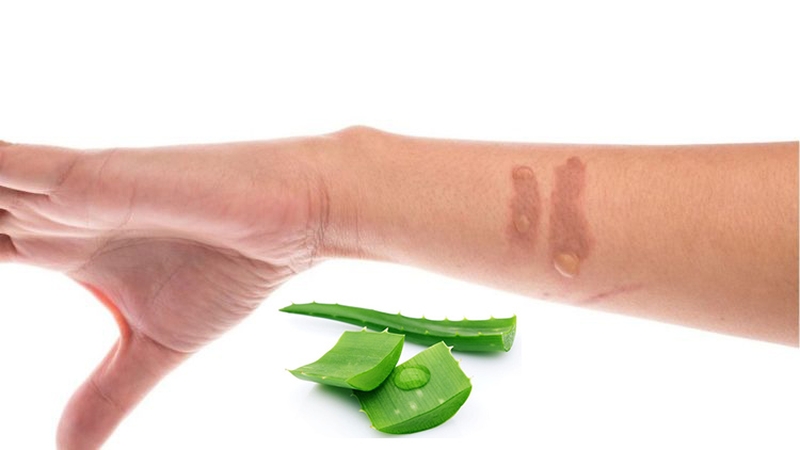 Nên làm gì khi bị bỏng nước sôi 3