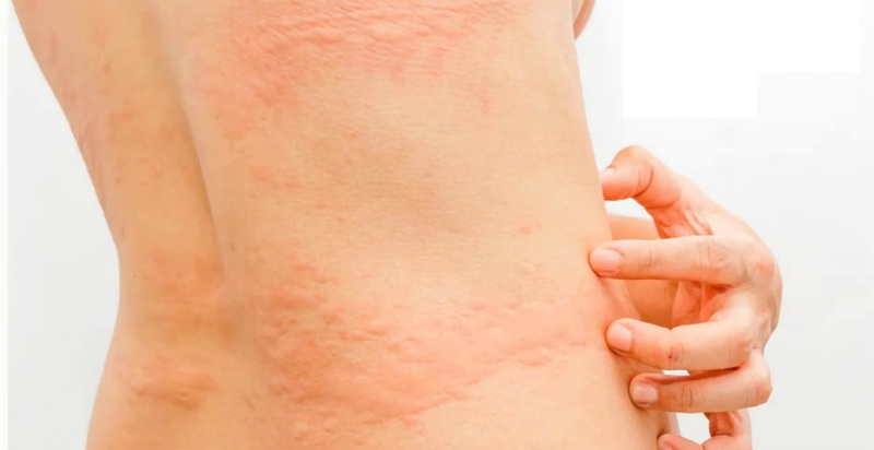 Dị ứng làm xuất hiện các mẩn đỏ gây&nbsp;cảm giác ngứa ngáy khó chịu