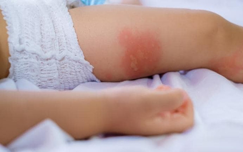 Nên làm gì khi bị muỗi độc đốt sưng to 1