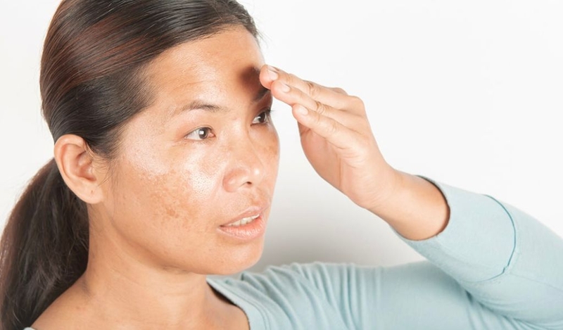 Nên làm gì khi da bị tăng sắc tố sau lăn kim? Nguyên nhân tăng sắc tố? 1