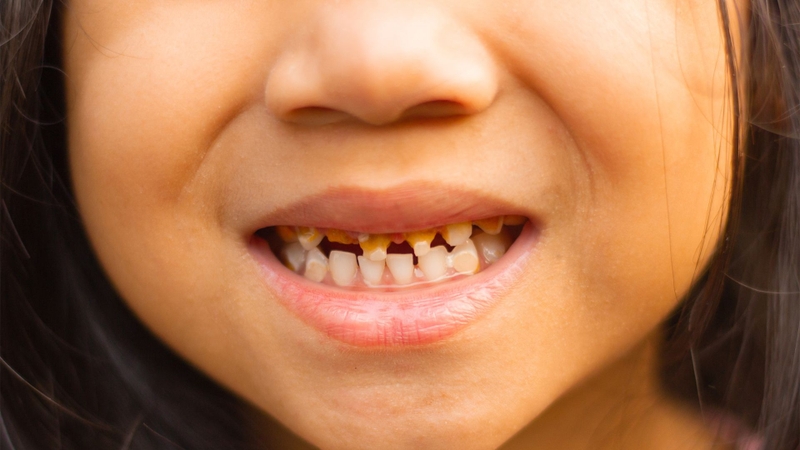 Nên làm gì khi em bé bị sâu răng sữa? Phòng ngừa sâu răng ở trẻ 2