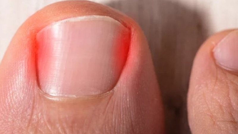 Nên làm gì khi lấy khóe móng chân bị sưng mủ? 1