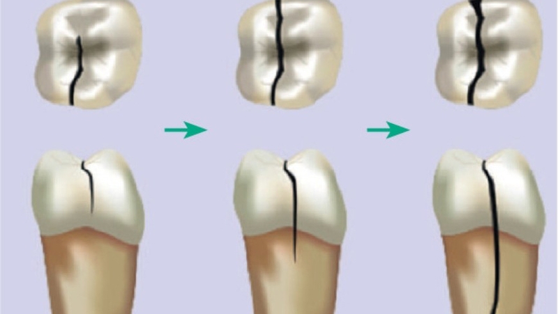 Nên làm gì khi răng bị vỡ dọc? 1