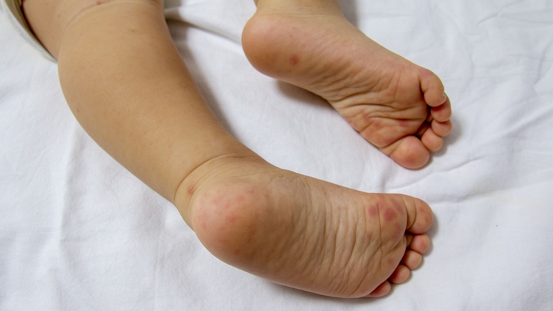 Phát hiện sớm dấu hiệu bất thường giúp đảm bảo an toàn cho trẻ khi mắc tay chân miệng
