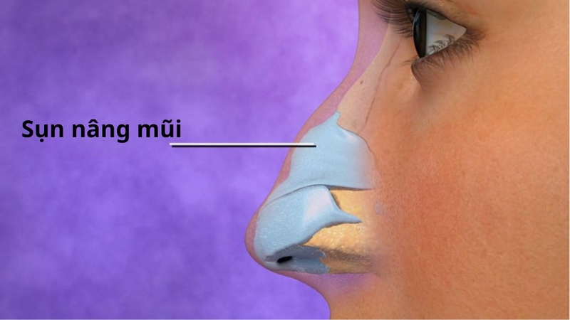 Nên nâng mũi bằng sụn tự thân hay nhân tạo&nbsp;là băn khoăn của nhiều người