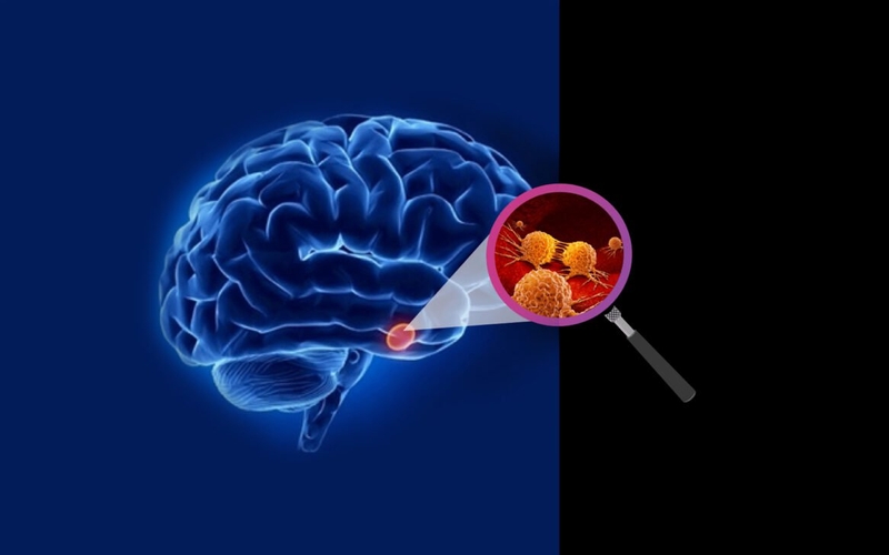 Ảnh hưởng của sóng điện thoại có thể gây u não