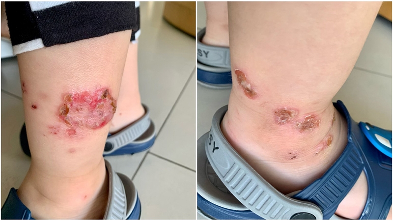 Nên thận trọng khi trẻ bị chốc lở ngoài da 2