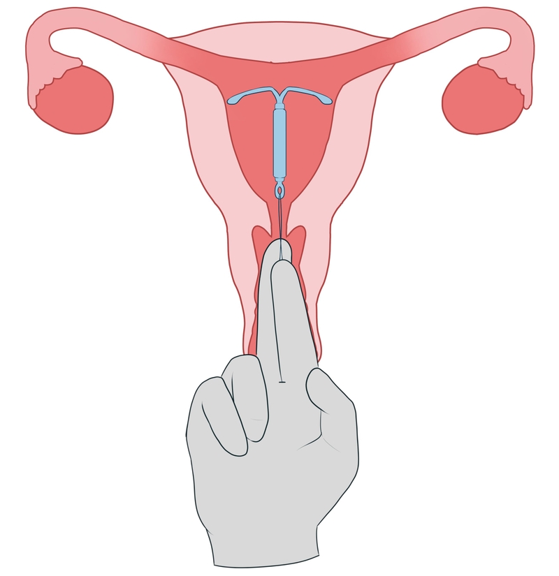 Nên tháo vòng tránh thai khi nào? Những điều cần lưu ý1