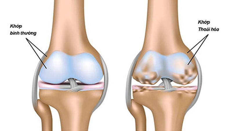 Nên uống sụn vi cá mập hay glucosamine? Hai sản phẩm này có gì khác nhau?3