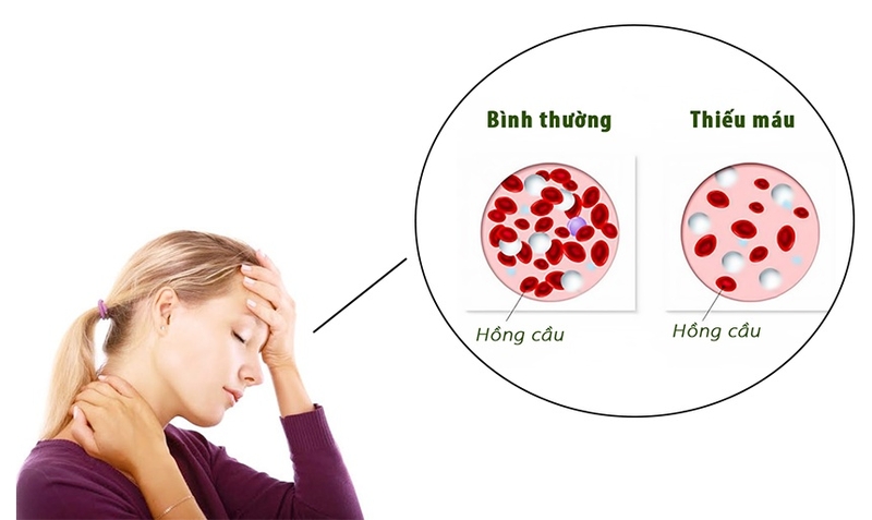 Nên uống thuốc sắt vào thời điểm nào trong ngày tốt nhất 3