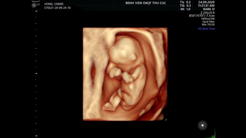 Nên xét nghiệm Double test tuần bao nhiêu trong thai kỳ? 3