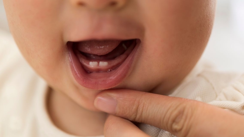 Răng cửa chìa ra phía trước có thể là dấu hiệu cần được theo dõi sớm