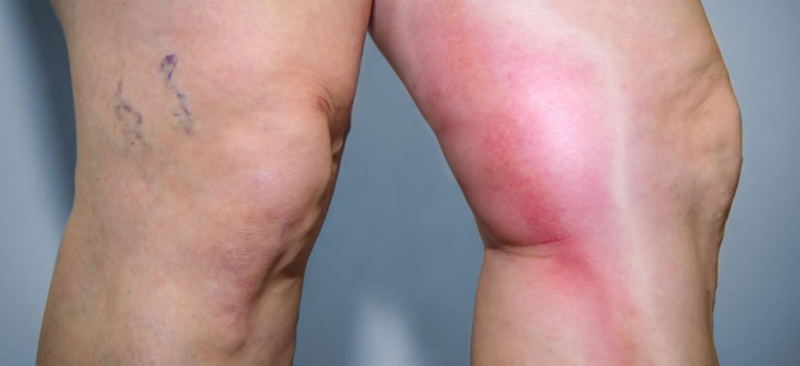 Ngăn ngừa huyết khối tĩnh mạch sâu cần làm gì? 4