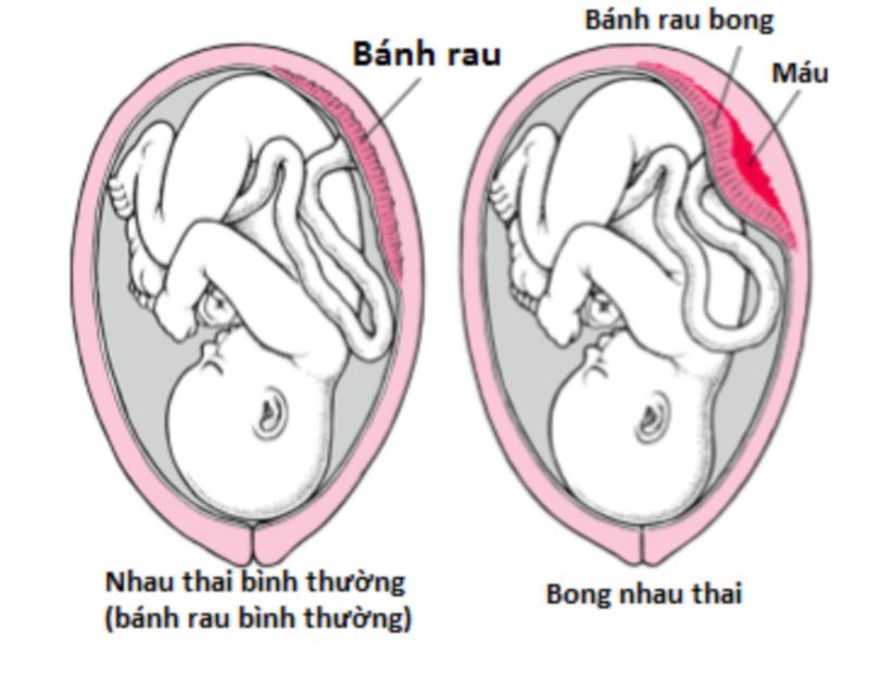 Nghiệm pháp bong rau là gì? Nghiệm pháp bong rau quan trọng ra sao 3