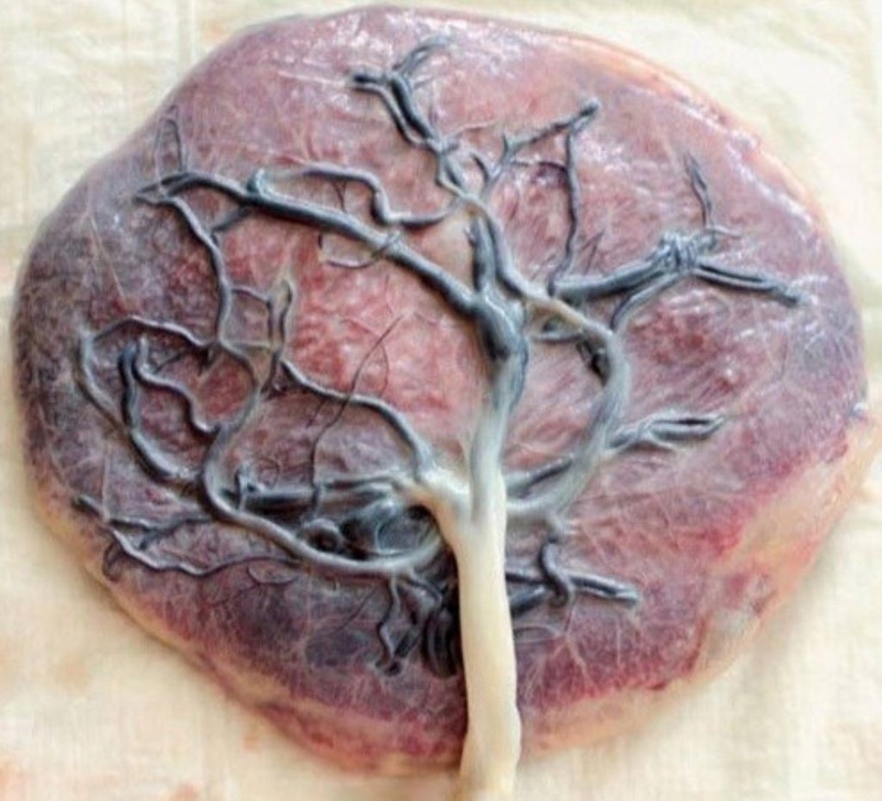 Nghiệm pháp bong rau là gì? Nghiệm pháp bong rau quan trọng ra sao 4