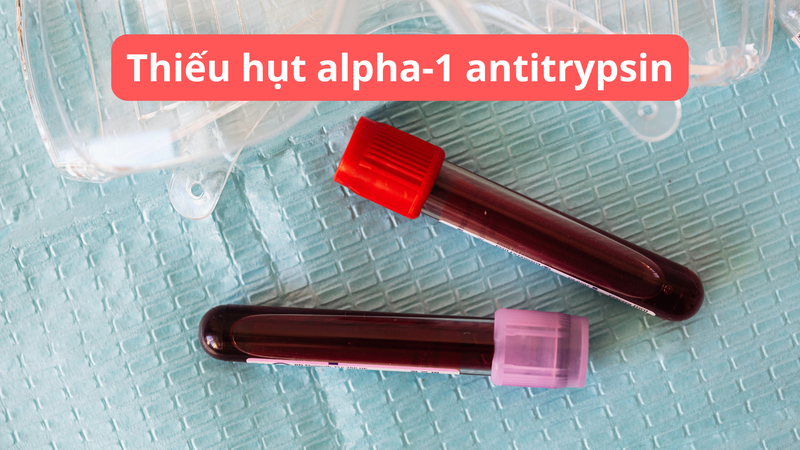 Xét nghiệm máu là phương pháp đơn giản để chẩn đoán thiếu hụt alpha-1 antitrypsin
