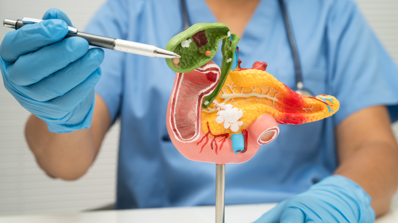 Mô phỏng giải phẫu túi mật bị viêm