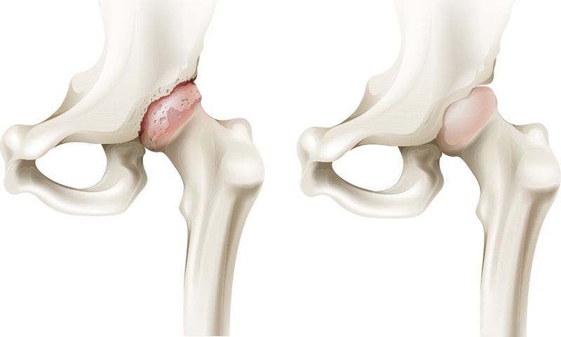 Nghiệm pháp patrick: Cách thực hiện và ý nghĩa chẩn đoán bệnh 1