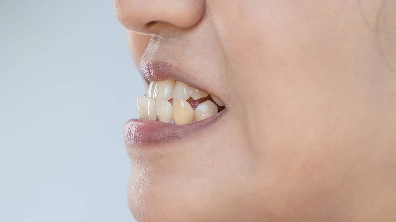 Nghiến răng khi ngủ còn làm thay đổi khớp cắn, khiến gương mặt mất cân đối