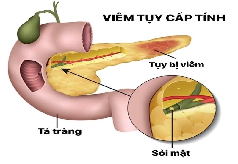 Nghiện rượu: Nguyên nhân của viêm tụy cấp?1