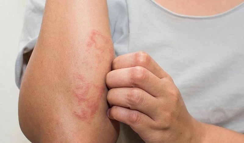 Ngộ độc quinin là gì? Có nguy hiểm không? Điều trị như thế nào? 2