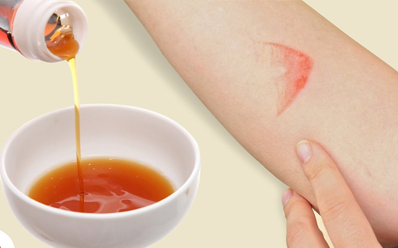 Cách sơ cứu khi bị bỏng lửa đúng khoa học giúp giảm biến chứng 4