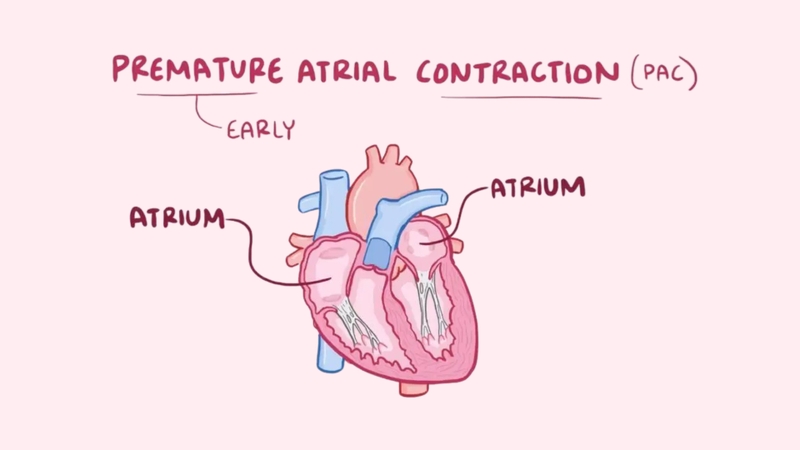 Ngoại tâm thu nhĩ là một dạng rối loạn nhịp tim đặc trưng bởi sự co bóp sớm bất thường của tâm nhĩ