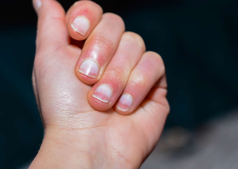 Ngón tay dùi trống là gì – bạn đã biết chưa?1