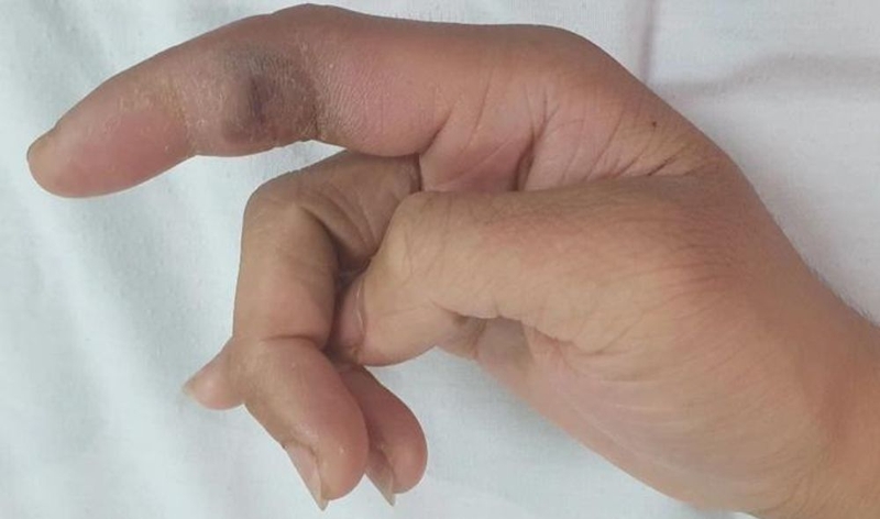 Ngón tay Mallet có thể phục hồi bình thường không? 1