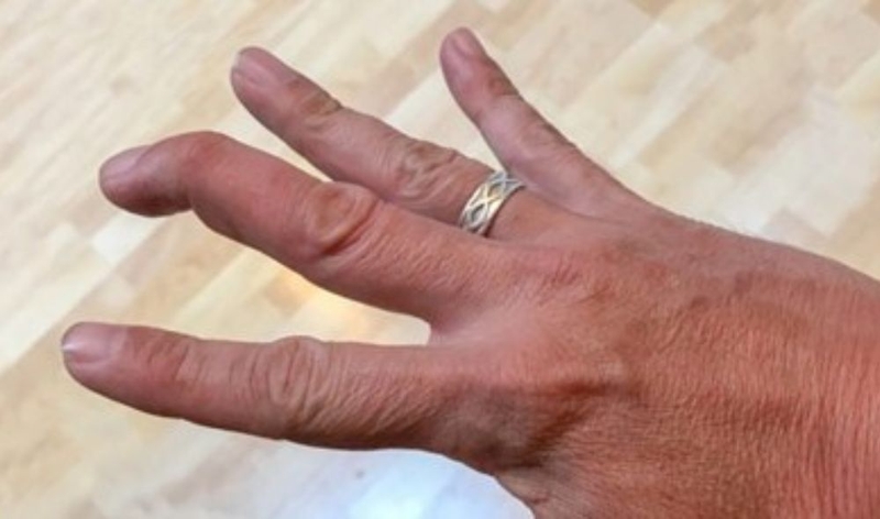 Ngón tay Mallet có thể phục hồi bình thường không? 3