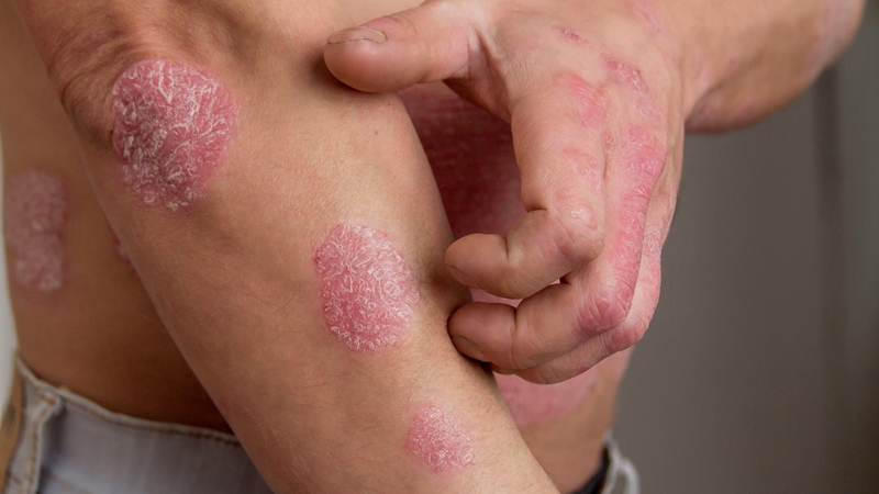 Nguyên nhân bị ngứa da vào ban đêm và phương pháp điều trị hiệu quả 3