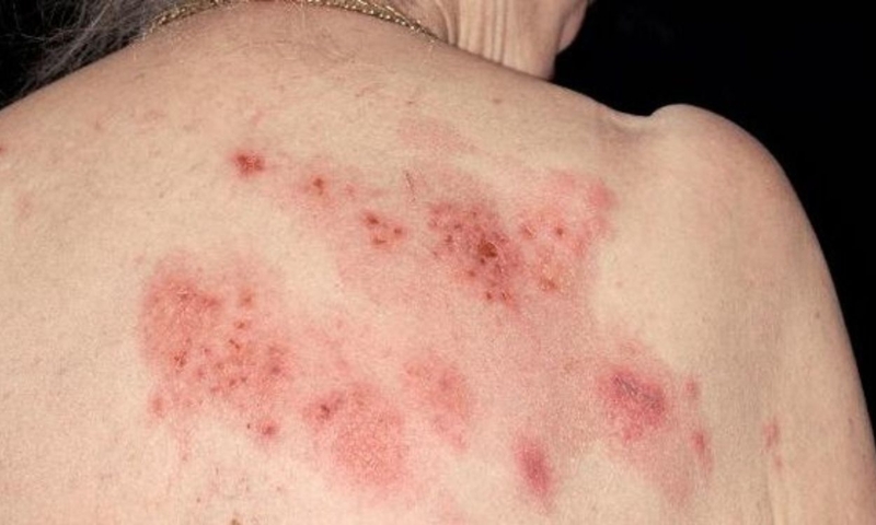 Ngứa do suy thận​: Nguyên nhân và cách điều trị 4