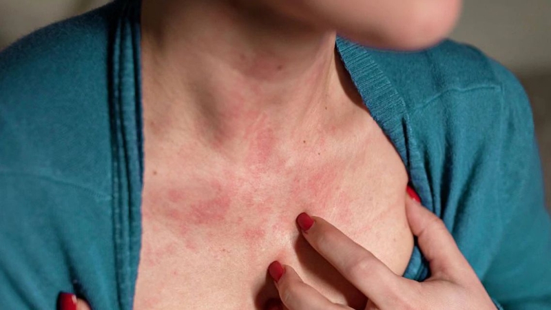 Bệnh lý gan mật có thể làm suy giảm dòng chảy của mật, gây ứ mật
