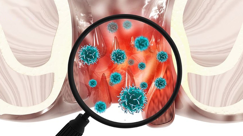 Ngứa hậu môn có phải bị giun không? 2