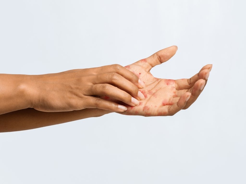 Ngứa lòng bàn tay: Nguyên nhân, triệu chứng và biện pháp phòng ngừa 1