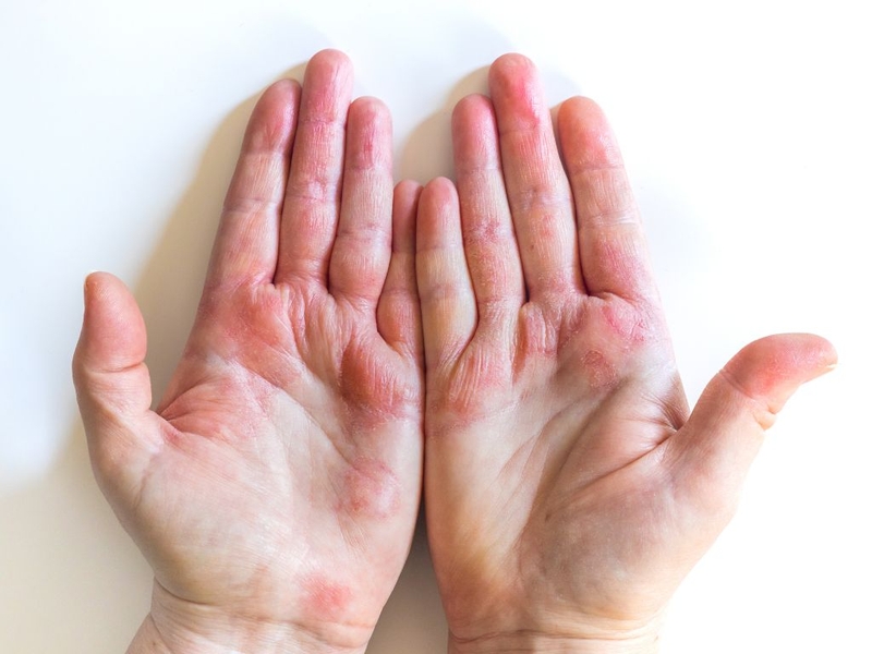 Ngứa lòng bàn tay: Nguyên nhân, triệu chứng và biện pháp phòng ngừa 2