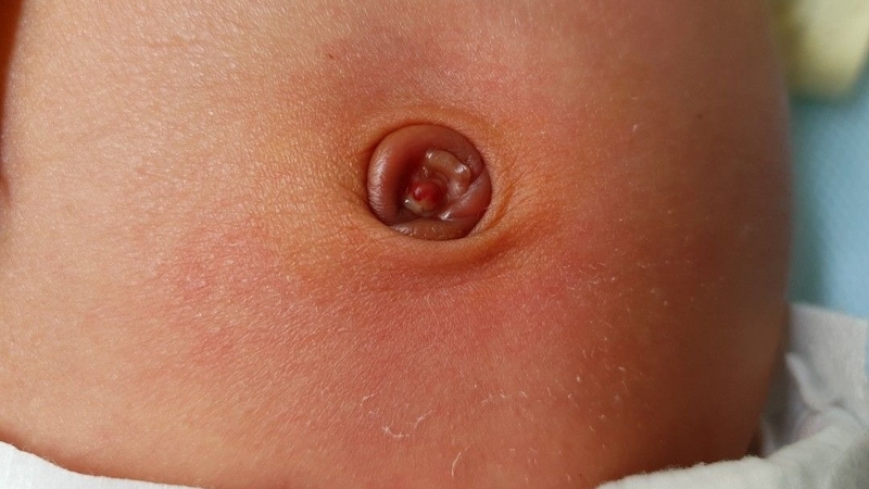 Ngứa rốn cảnh báo những bệnh đáng chú ý -2