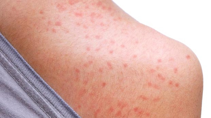Ngứa toàn thân là bệnh gì? Hiểu rõ nguyên nhân và cách điều trị 2