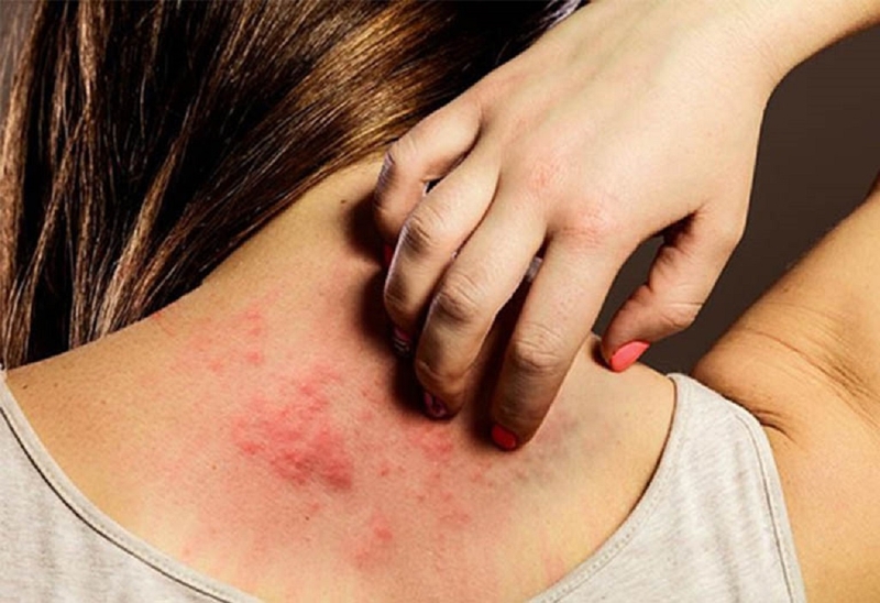 Người bệnh bị phong ngứa uống thuốc gì an toàn và hiệu quả nhất? 1