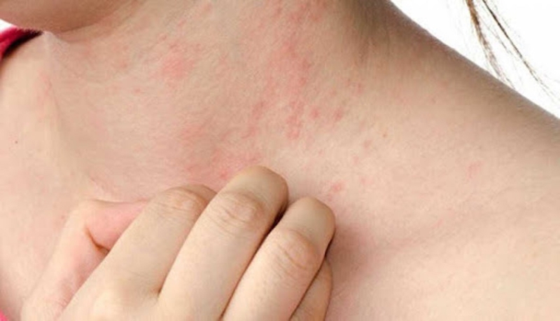 Người bệnh bị phong ngứa uống thuốc gì an toàn và hiệu quả nhất? 2