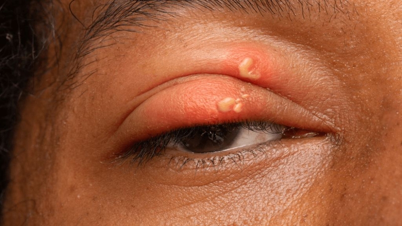 Người bệnh bị zona bôi thuốc gì nhanh khỏi, hiệu quả nhất? 2