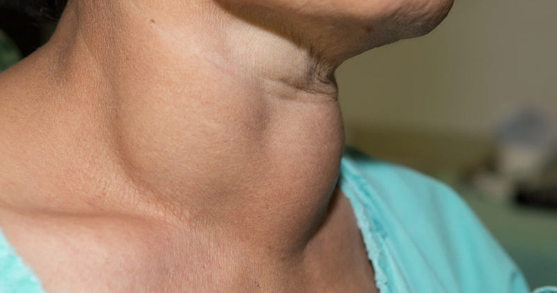 Người bị bướu cổ có nên uống bột sắn dây không? 1