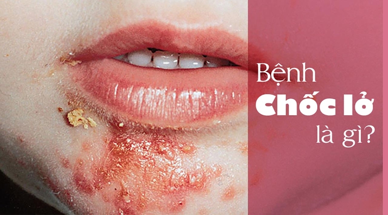 Người bệnh chốc lở nặng nên làm gì để nhanh khỏi bệnh