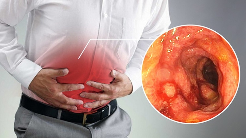 Người bệnh viêm trực tràng kiêng ăn gì và nên ăn gì? 4